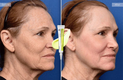 Vita A Retinal Tightening Booster™ | Selling Out Fast!
